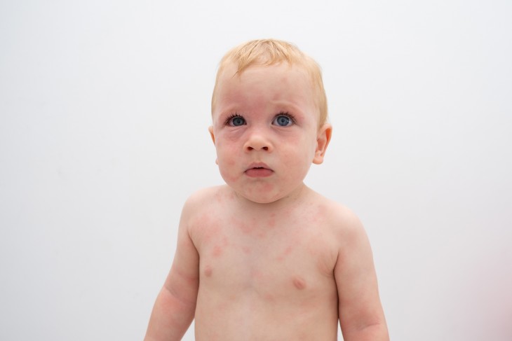 Allergiás reakciót mutató kisgyermek. Töredékére csökkenthető lenne az ételallergiások száma? Fotó: Depositphotos