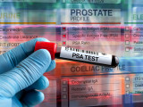 Rekordszámú prosztatarák-szűrés történt tavaly