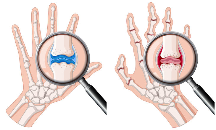 a rheumatoid arthritis fáj az ízületekre ízületi fájdalom a fogszuvasodás miatt