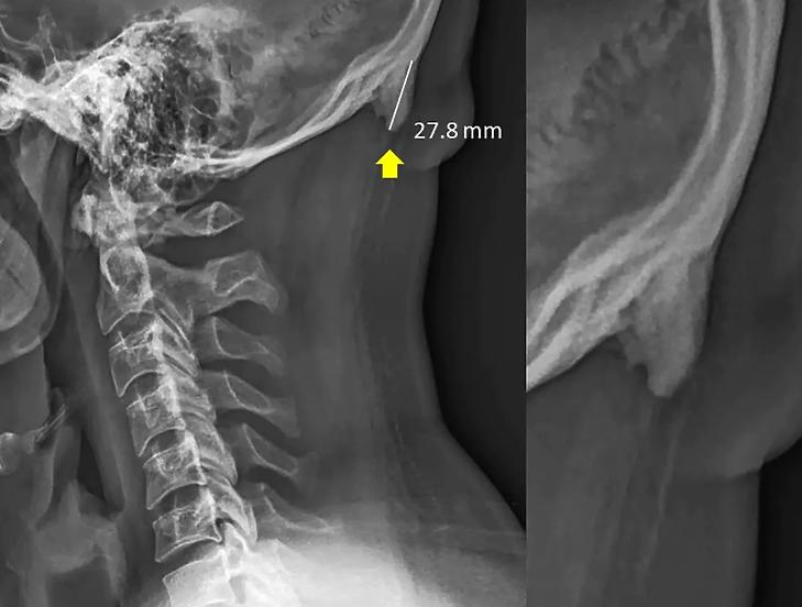 Jól látható a szarv a koponya hátsó részén. (Forrás: Nature)